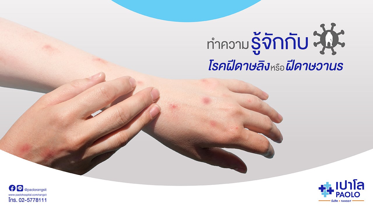 โรคฝีดาษลิง หรือ Monkeypox โรคระบาดใหม่ที่ไม่ควรมองข้าม